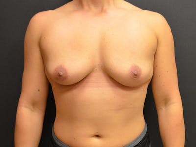 En Bloc Capsulectomy Before & After Gallery - Patient 167358263 - Image 2