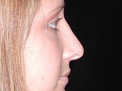 Rhinoplasty Before & After Gallery - Patient 167358258 - Image 2