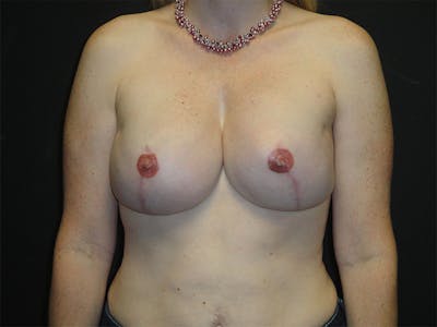 Breast Implant Reconstruction Before & After Gallery - Patient 167358265 - Image 2