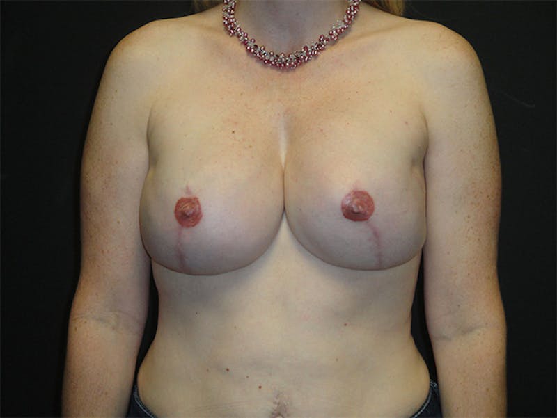 Breast Implant Reconstruction Before & After Gallery - Patient 167358265 - Image 2