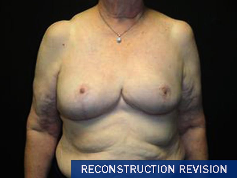 Breast Revision Before & After Gallery - Patient 167358260 - Image 2