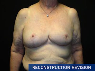 Breast Revision Before & After Gallery - Patient 167358260 - Image 2