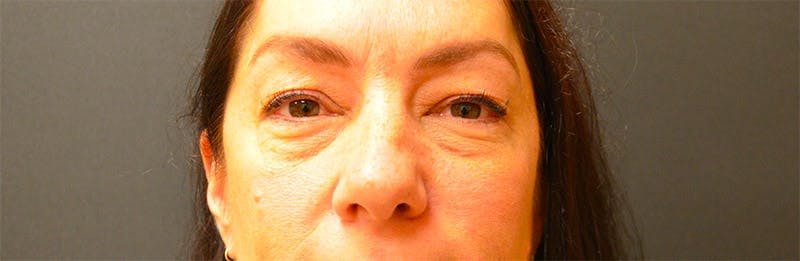 Eyelid Surgery Before & After Gallery - Patient 167358259 - Image 1