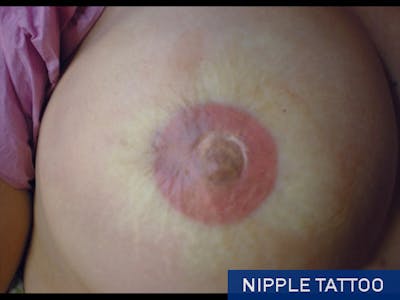 Nipple Correction Before & After Gallery - Patient 167358257 - Image 2