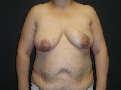 Breast Flap Reconstruction Before & After Gallery - Patient 167358277 - Image 1