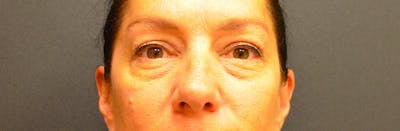 Eyelid Surgery Before & After Gallery - Patient 167358259 - Image 2