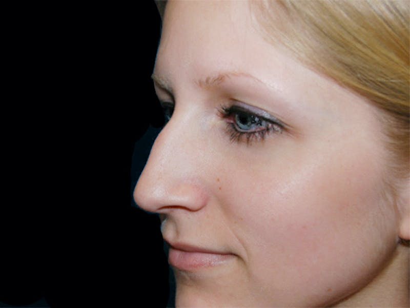 Rhinoplasty Before & After Gallery - Patient 167358268 - Image 1