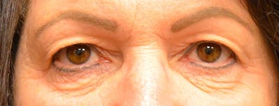 Eyelid Surgery Before & After Gallery - Patient 167358267 - Image 1