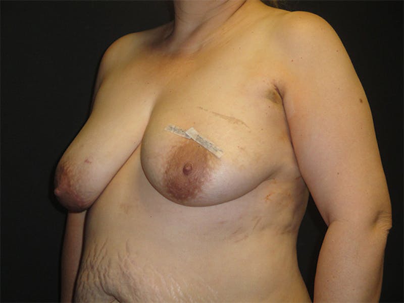 Breast Flap Reconstruction Before & After Gallery - Patient 167358277 - Image 3