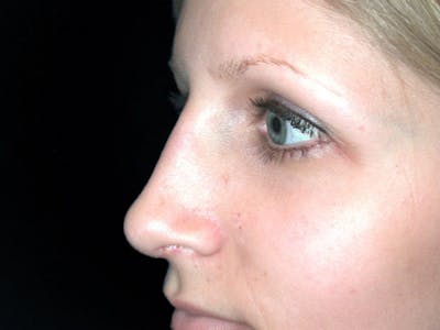 Rhinoplasty Before & After Gallery - Patient 167358268 - Image 2
