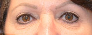 Eyelid Surgery Before & After Gallery - Patient 167358267 - Image 2