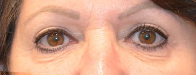 Eyelid Surgery Before & After Gallery - Patient 167358267 - Image 2