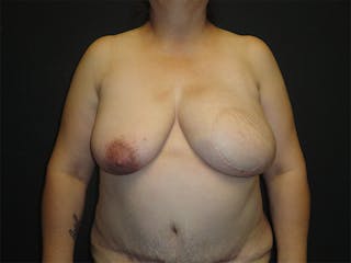Breast Flap Reconstruction Before & After Gallery - Patient 167358277 - Image 4