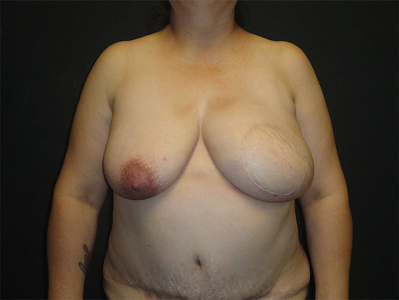 Breast Flap Reconstruction Before & After Gallery - Patient 167358277 - Image 4