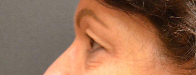 Eyelid Surgery Before & After Gallery - Patient 167358267 - Image 3