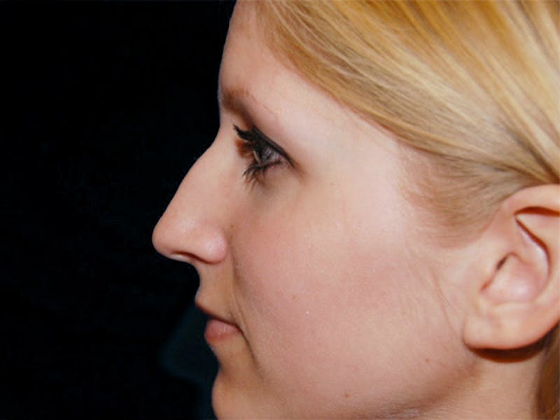 Rhinoplasty Before & After Gallery - Patient 167358268 - Image 3