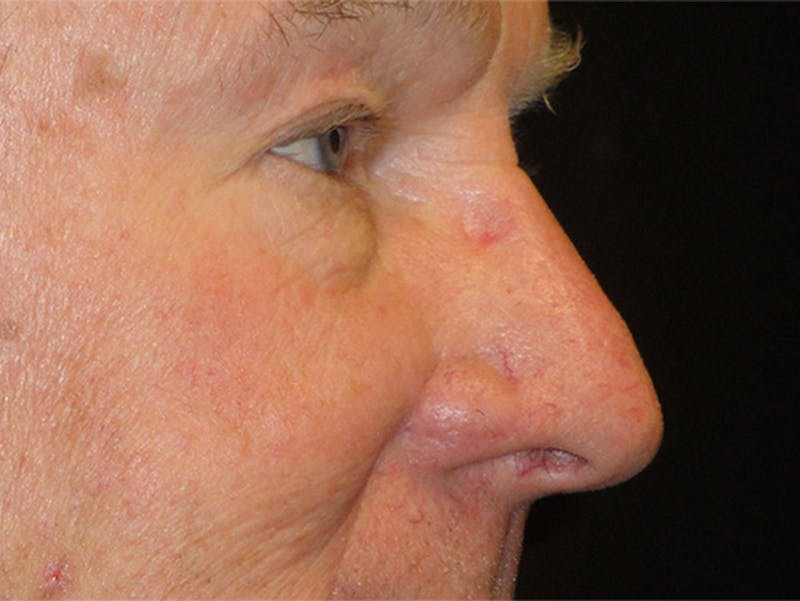 Face Reconstruction Before & After Gallery - Patient 167358279 - Image 2