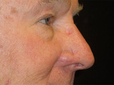 Face Reconstruction Before & After Gallery - Patient 167358279 - Image 2
