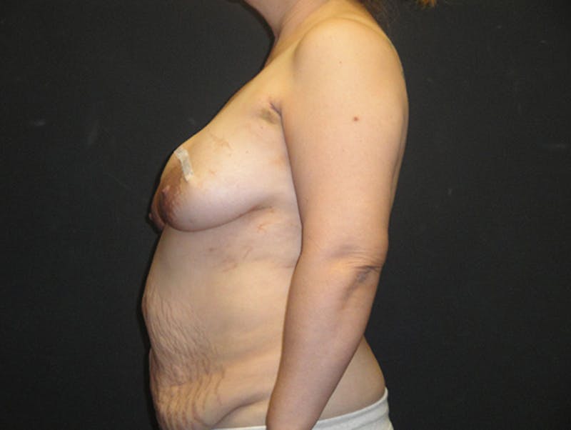 Breast Flap Reconstruction Before & After Gallery - Patient 167358277 - Image 5