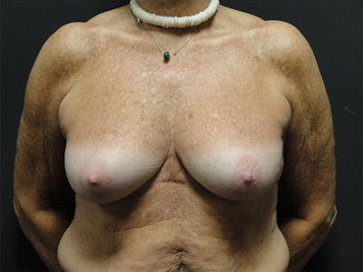 Breast Implant Reconstruction Before & After Gallery - Patient 167358291 - Image 1