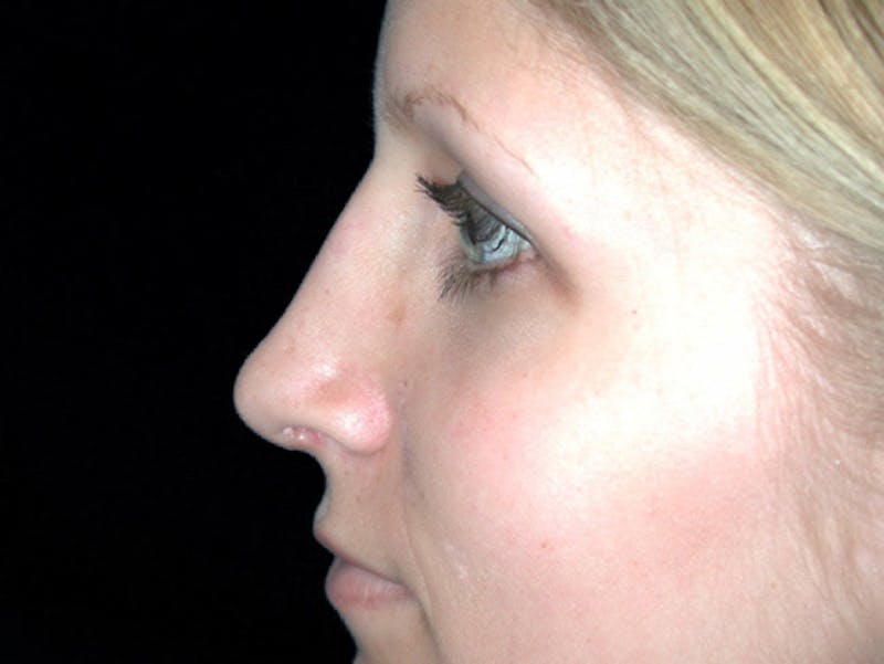 Rhinoplasty Before & After Gallery - Patient 167358268 - Image 4
