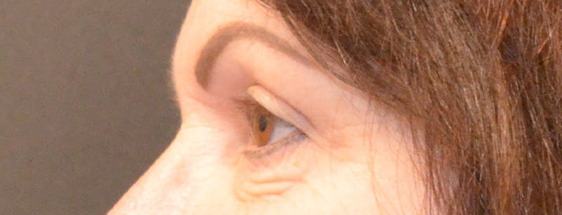 Eyelid Surgery Before & After Gallery - Patient 167358267 - Image 4