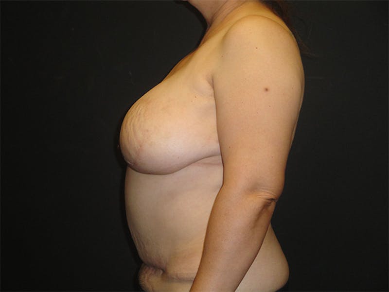 Breast Flap Reconstruction Before & After Gallery - Patient 167358277 - Image 6