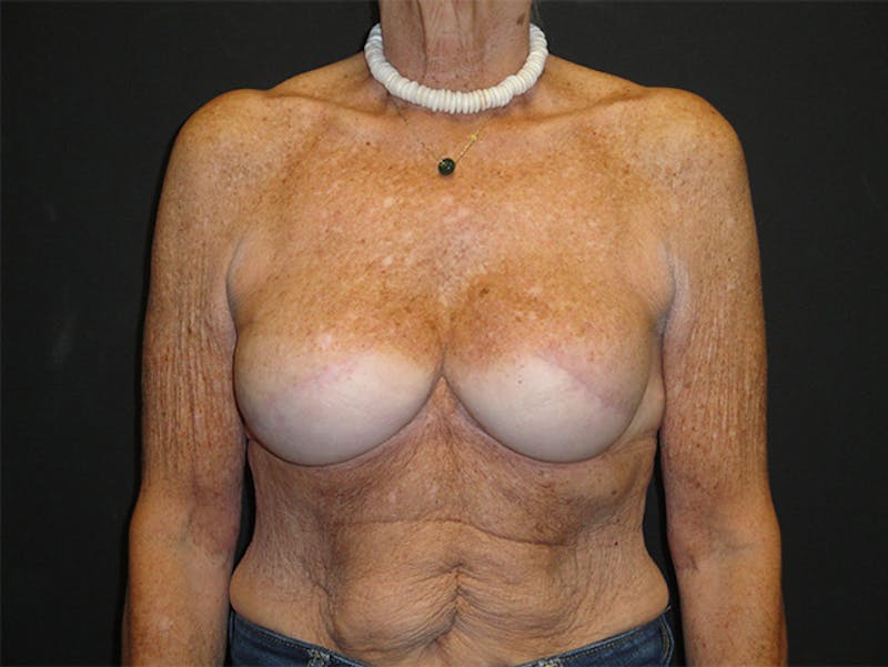 Breast Implant Reconstruction Before & After Gallery - Patient 167358291 - Image 2