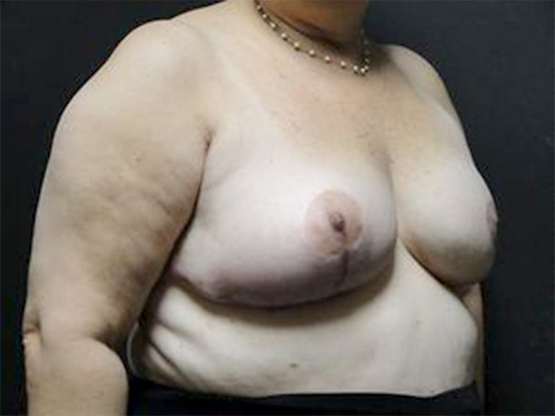 Breast Revision Before & After Gallery - Patient 167358278 - Image 4