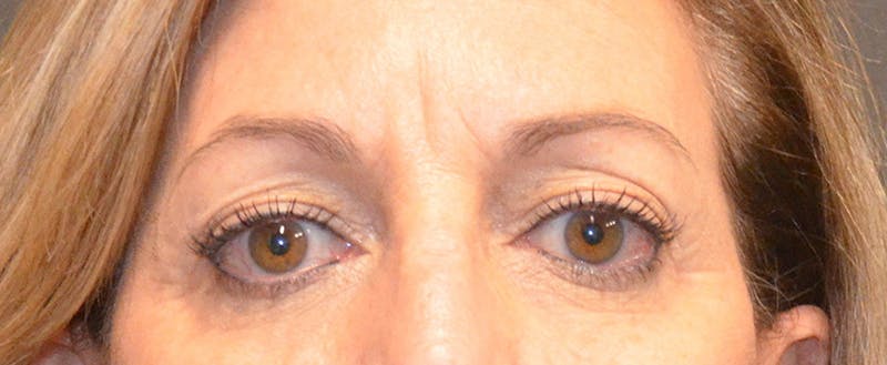 Eyelid Surgery Before & After Gallery - Patient 167358287 - Image 1