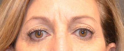 Eyelid Surgery Before & After Gallery - Patient 167358287 - Image 1