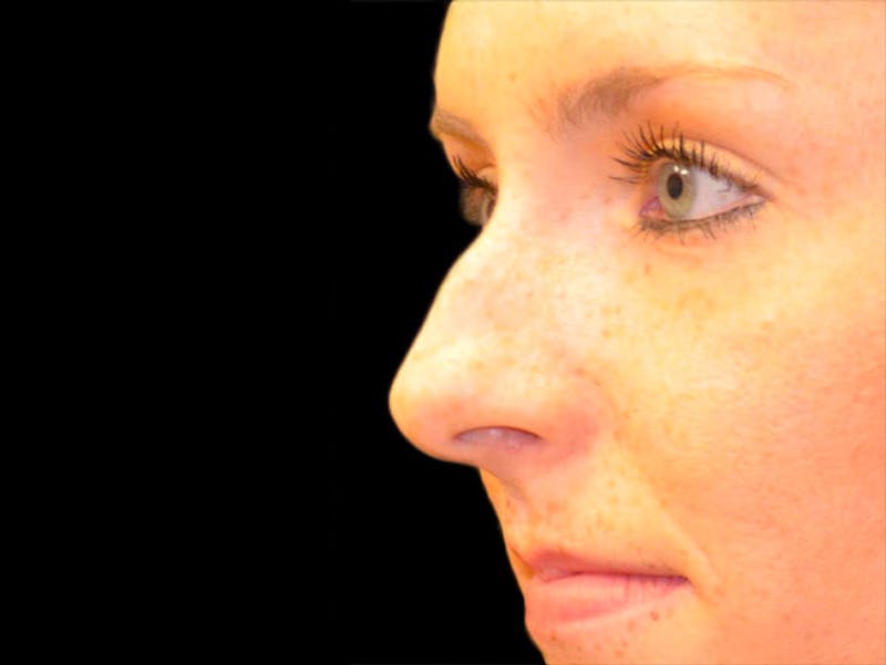 Rhinoplasty Before & After Gallery - Patient 167358282 - Image 1