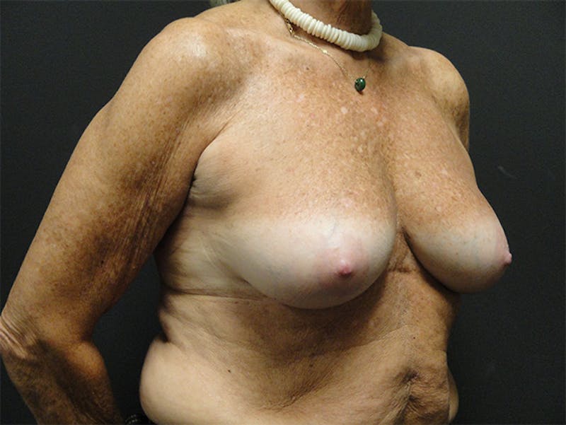 Breast Implant Reconstruction Before & After Gallery - Patient 167358291 - Image 3