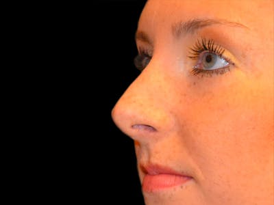 Rhinoplasty Before & After Gallery - Patient 167358282 - Image 2