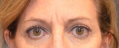 Eyelid Surgery Before & After Gallery - Patient 167358287 - Image 2
