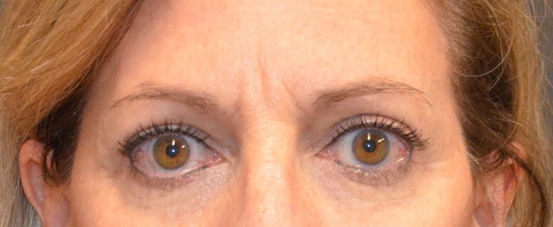 Eyelid Surgery Before & After Gallery - Patient 167358287 - Image 2