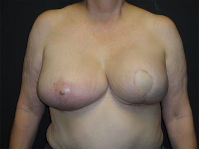 Breast Flap Reconstruction Before & After Gallery - Patient 167358292 - Image 2