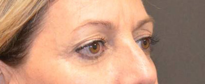Eyelid Surgery Before & After Gallery - Patient 167358287 - Image 3
