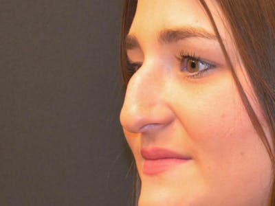 Rhinoplasty Before & After Gallery - Patient 167358289 - Image 1
