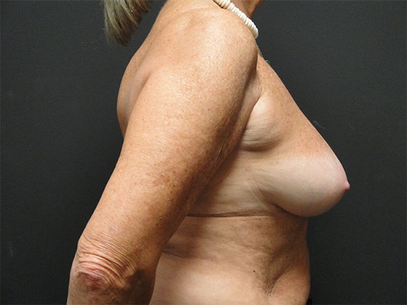 Breast Implant Reconstruction Before & After Gallery - Patient 167358291 - Image 5