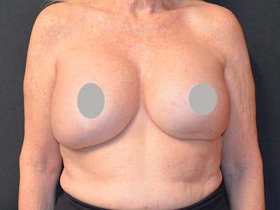 En Bloc Capsulectomy Before & After Gallery - Patient 167358297 - Image 1