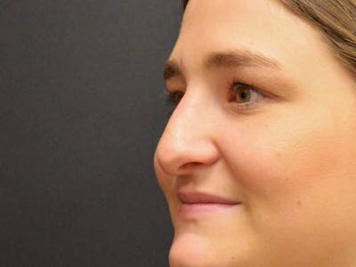 Rhinoplasty Before & After Gallery - Patient 167358289 - Image 2