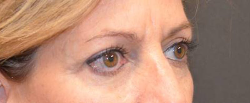 Eyelid Surgery Before & After Gallery - Patient 167358287 - Image 4