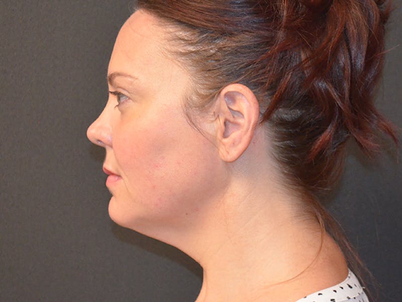 Chin Liposuction Before & After Gallery - Patient 167358288 - Image 3