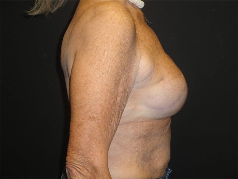 Breast Implant Reconstruction Before & After Gallery - Patient 167358291 - Image 6