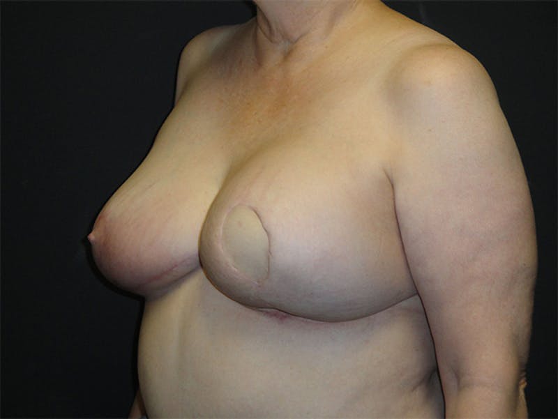 Breast Flap Reconstruction Before & After Gallery - Patient 167358292 - Image 4