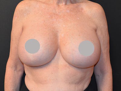 En Bloc Capsulectomy Before & After Gallery - Patient 167358297 - Image 2