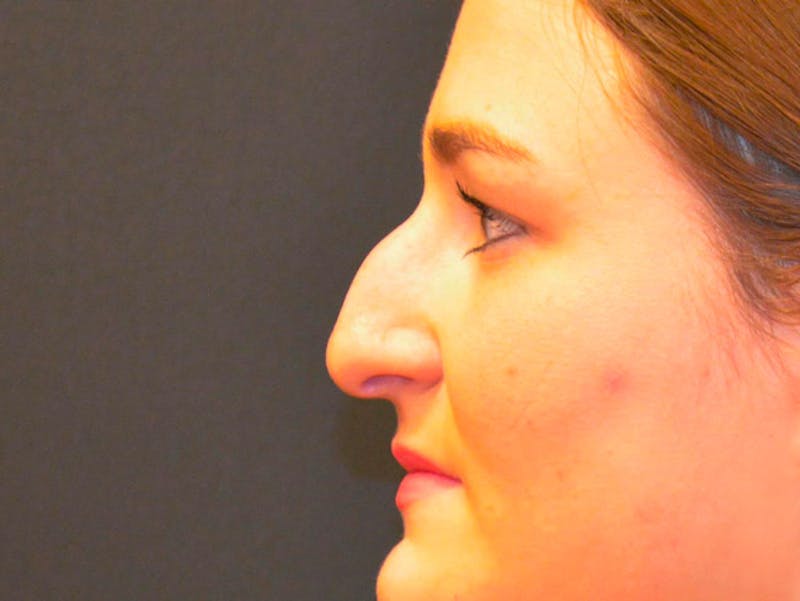 Rhinoplasty Before & After Gallery - Patient 167358289 - Image 3