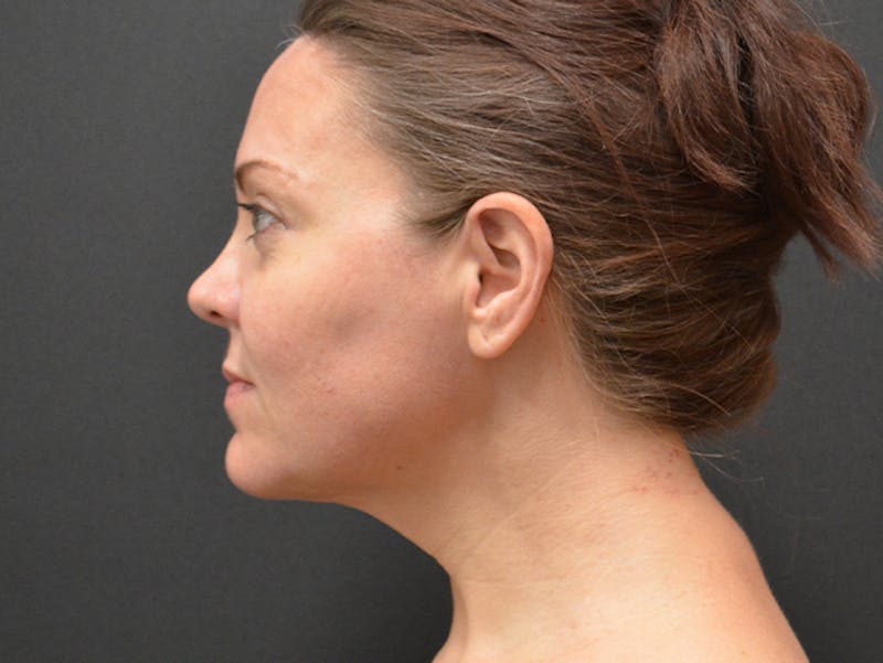 Chin Liposuction Before & After Gallery - Patient 167358288 - Image 4