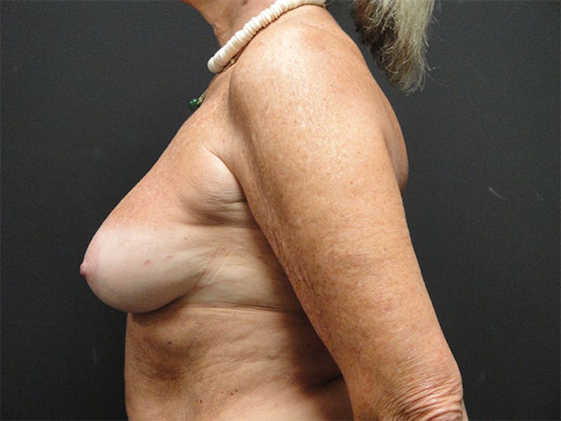 Breast Implant Reconstruction Before & After Gallery - Patient 167358291 - Image 7